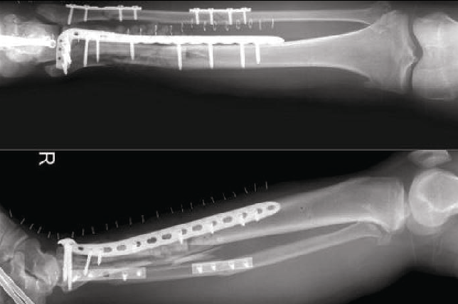 Custom Sensors For Bone Fractures & Surgical Applications